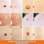 Hautwucherung Entferner Pen – Schnell und Effektiv – Für Gesicht und Körper