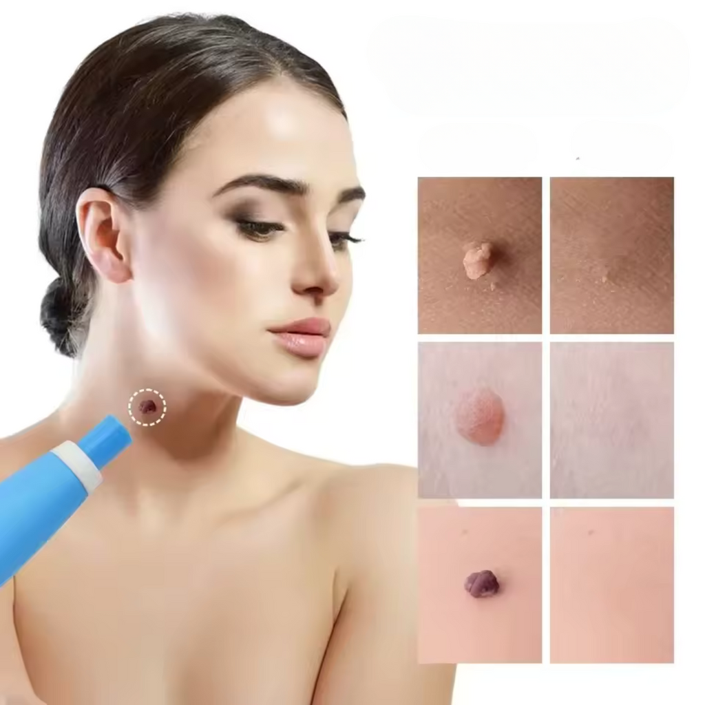 WarzenStop Stielwarzen-Entferner | Schmerzfrei Ohne Schneiden Für Gesicht & Körper