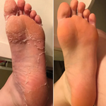 HydraCare Balm Duo | Intensive Feuchtigkeitspflege für Ihre Füße